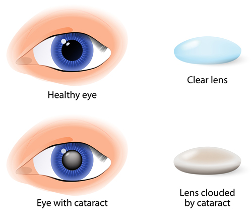 Healthy Eyes and Eye with Cataract