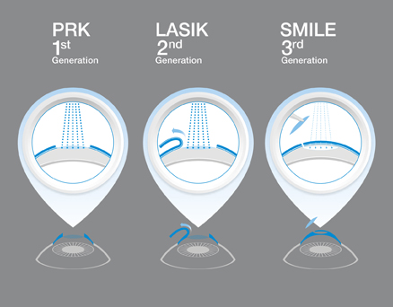 prk vs lasik vs smile