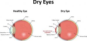 Dry Eye Treatment in Buckhead
