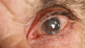close up of person's eye with cataract