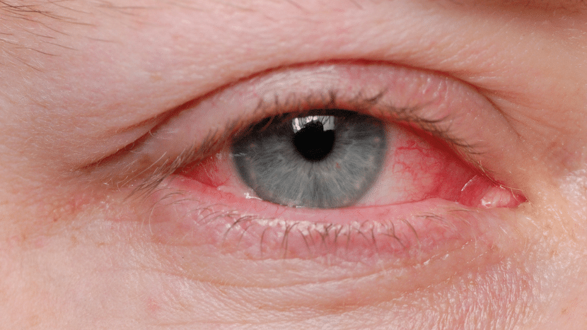 Pink Eye Condition